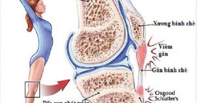 Viêm gân bánh chè tập thế nào để nhanh hồi phục